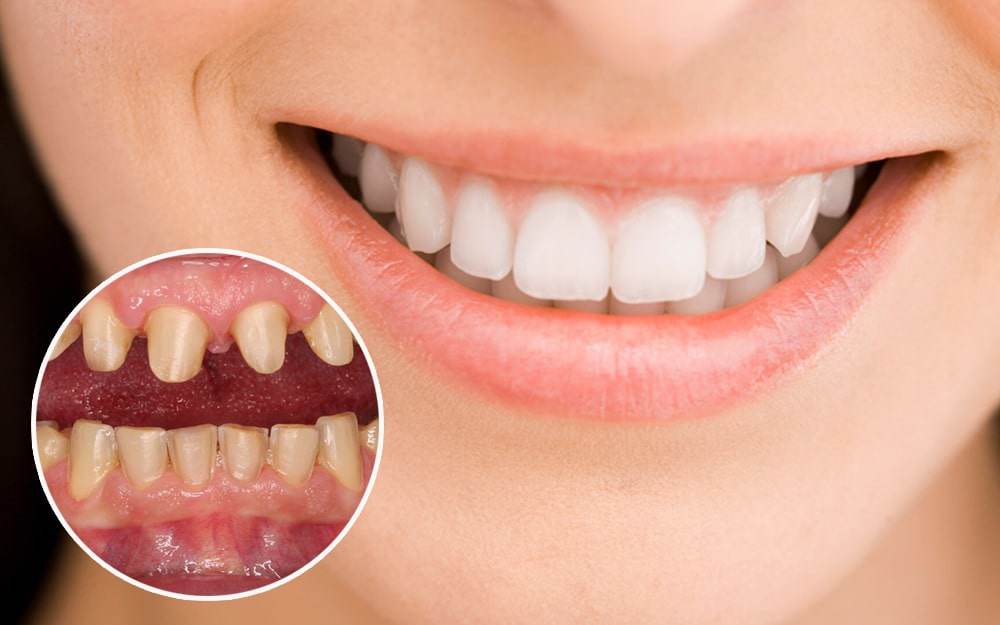 Muốn bọc răng sứ đẹp để tự tin đón Tết, chị em cần phải lưu ý những điều gì?