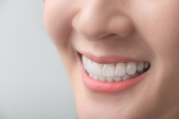 Giá niềng răng trong suốt trọn gói - Nha Khoa Elite Dental