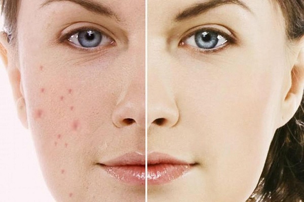 Những ưu điểm khi trị mụn tại Spa