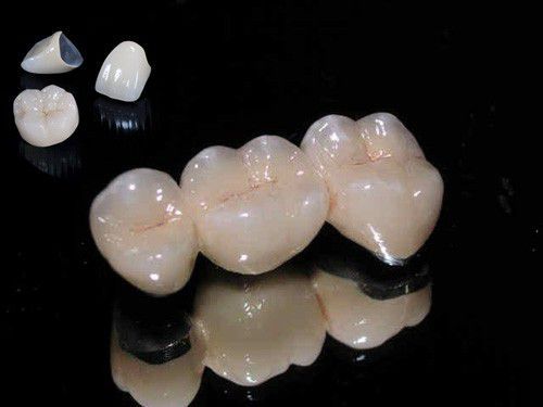 Răng sứ kim loại thường có độ bền bao lâu bạn có biết?