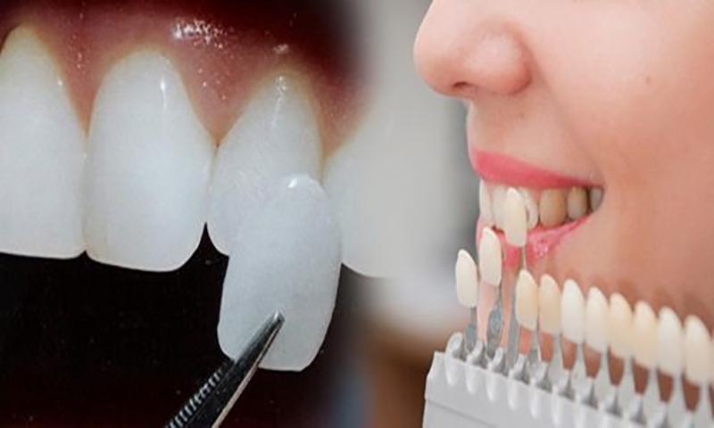 Mặt dán sứ Veneer – Công nghệ bảo tồn răng thật