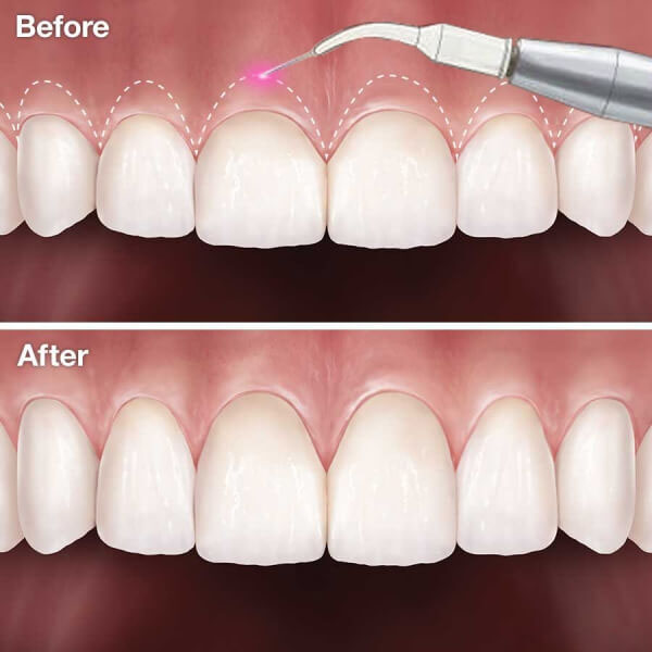 Phẫu thuật nướu giúp loại bỏ mô nướu thừa dính vào răng