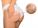 Top +20 Loại Kem Trị Thâm Mông Hiệu Quả Nhất & An Toàn Nhất