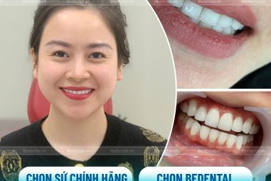 Răng Sứ Kim Loại Bị Đen ⚡️ Nguyên Nhân – Tác Hại – Cách Khắc Phục