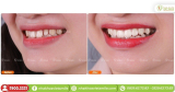 Có Nên Dán Sứ Veneer Không? ⚡️ Đối Tượng Nào Nên Dán Sứ Veneer?